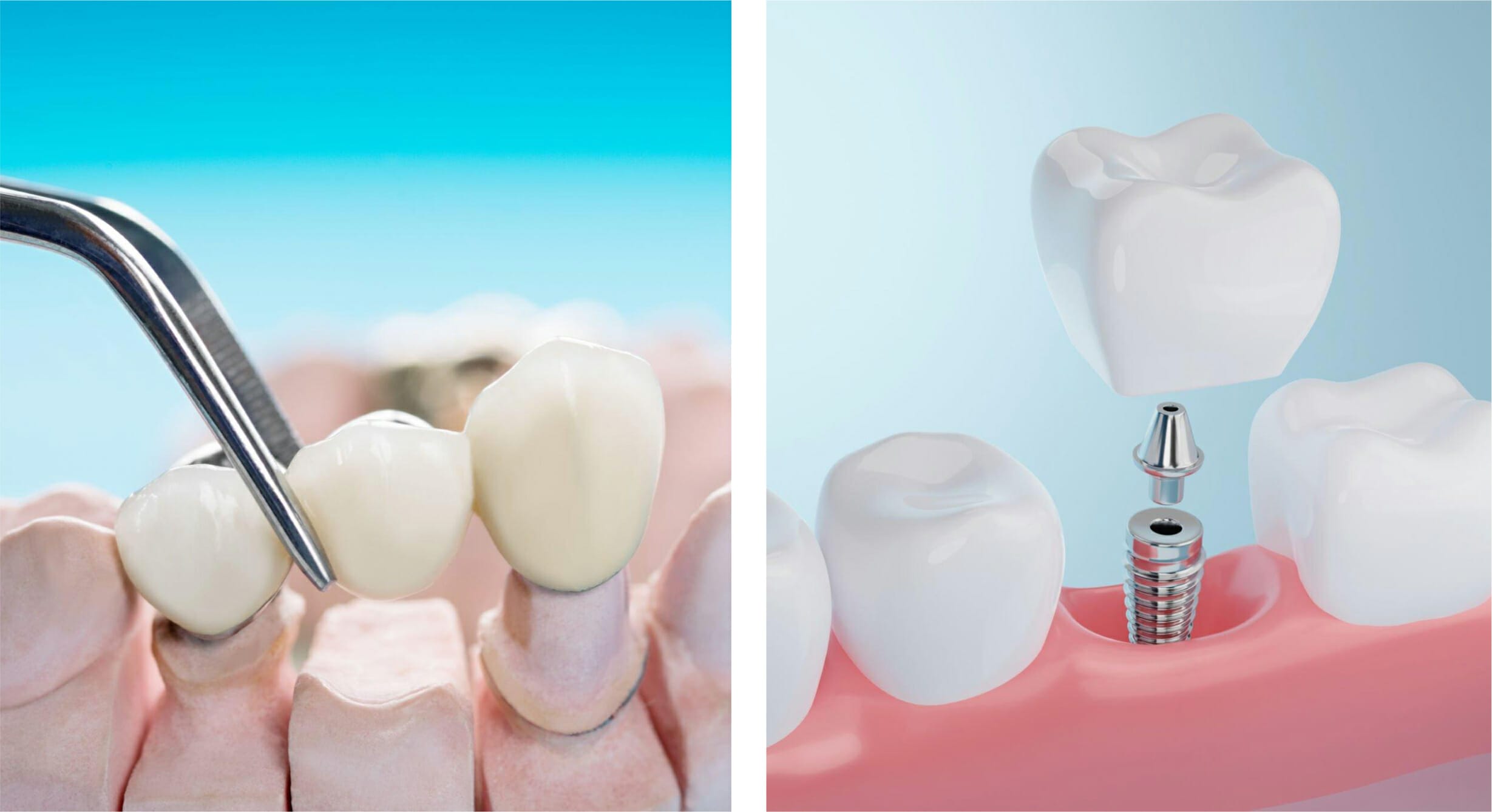 What is a Dental Bridge Look Like: Exploring the Appearance of Dental Bridges