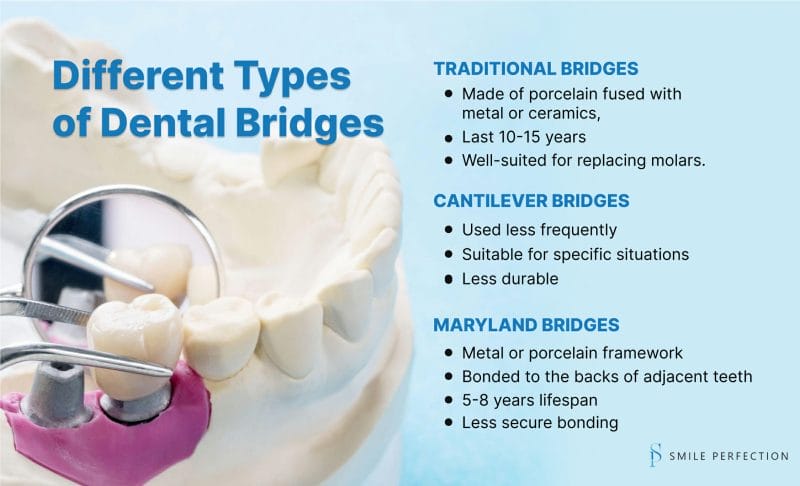 Different Types of Dental Bridges: Traditional Bridges, Cantilever Bridges, Maryland Bridges