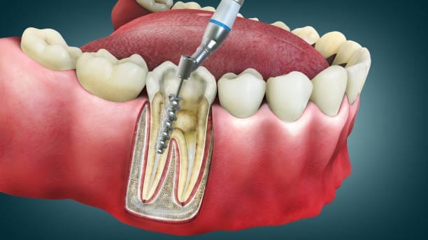 illustration of a root canal procedure in Tucson, AZ