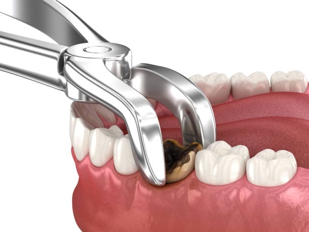 illustration of a tooth extraction in Tucson, AZ