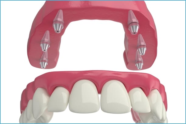 3D-rendered image of a top denture supported by dental implants, showcasing the secure implant posts anchored in the upper jaw and the realistic gum and teeth design for enhanced oral function and aesthetics.